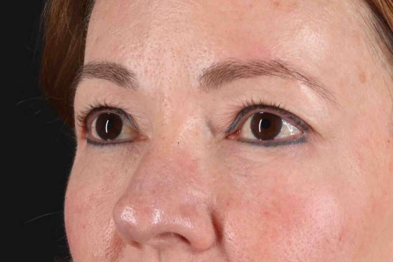 Laser Before & After Patient #2114