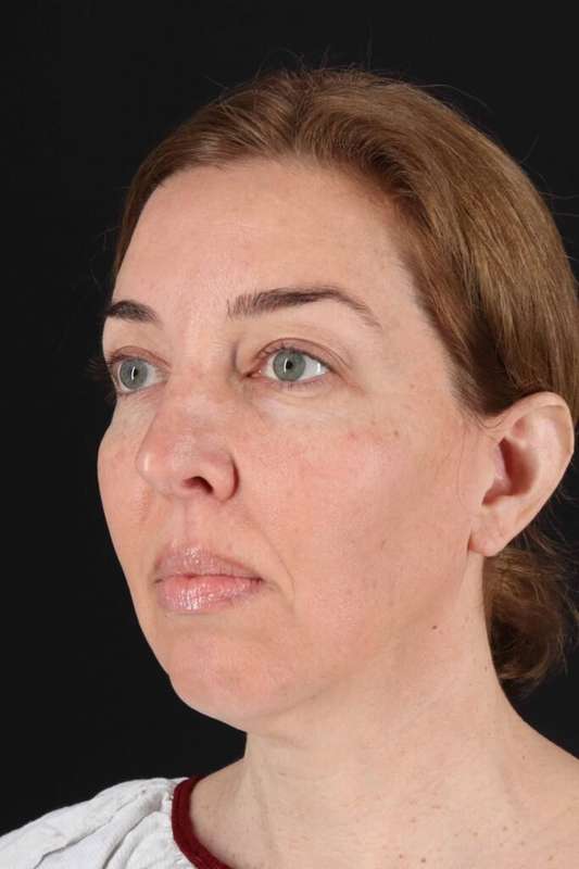 Laser Before & After Patient #2136