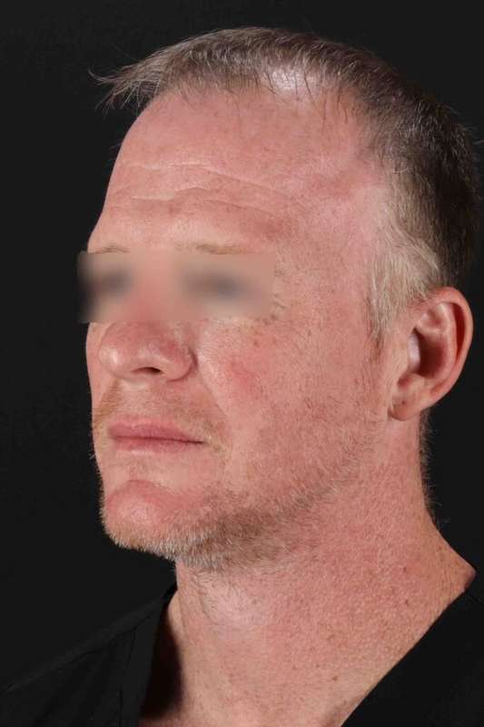 Laser Before & After Patient #2158