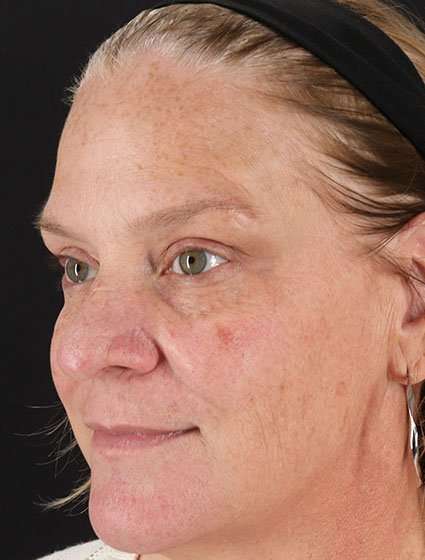Chemical Peel Before & After Patient #2169