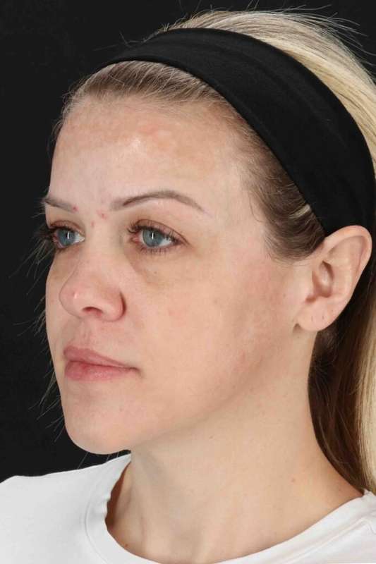 Chemical Peel Before & After Patient #2180