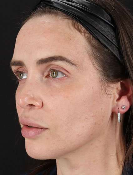 Chemical Peel Before & After Patient #2202