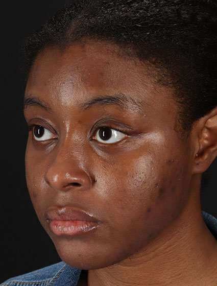 Chemical Peel Before & After Patient #2213