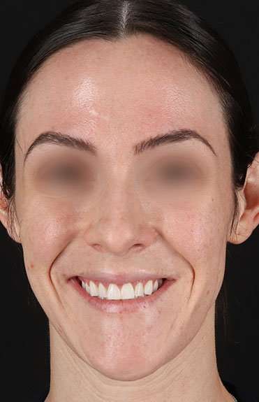 Cosmetic Injectables Before & After Patient #2236