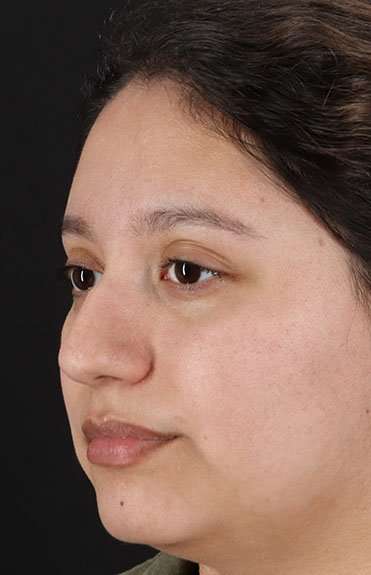 Cosmetic Injectables Before & After Patient #2253