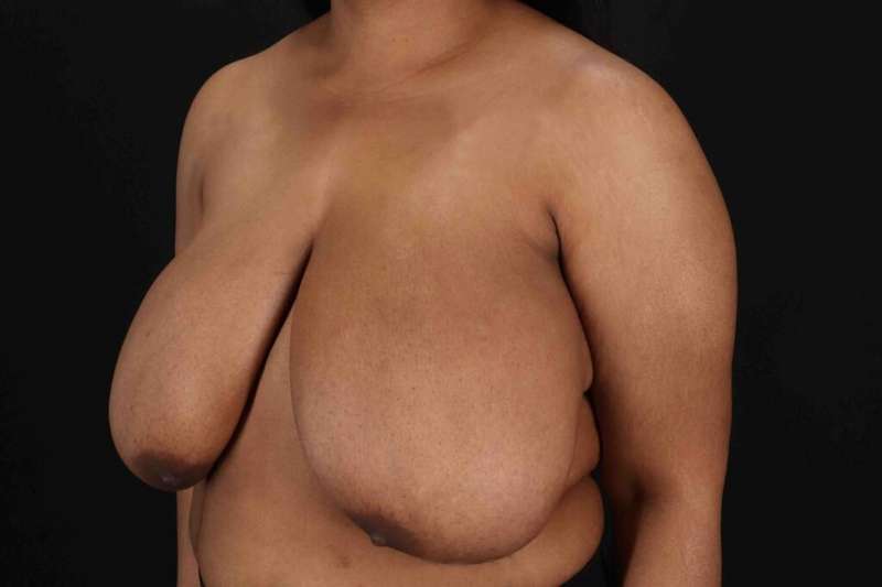 Breast Reduction with Lift Before & After Patient #928