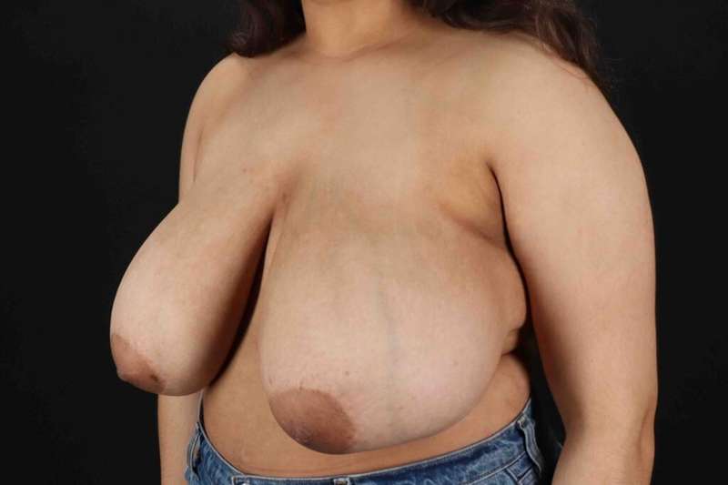 Breast Reduction with Lift Before & After Patient #1027