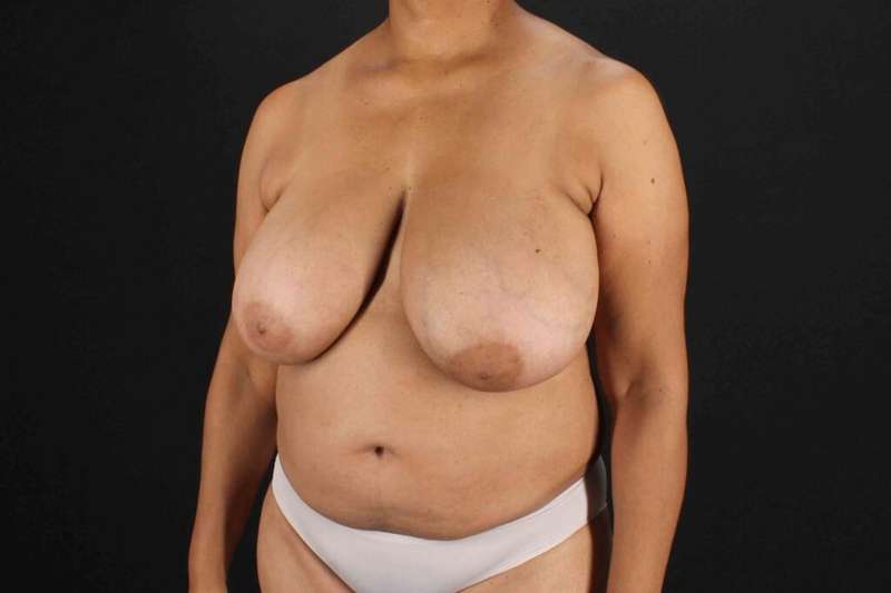 Breast Reconstruction Before & After Patient #1038