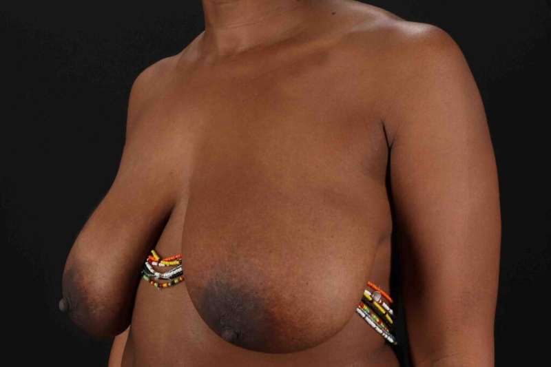Breast Lift Before & After Patient #1049