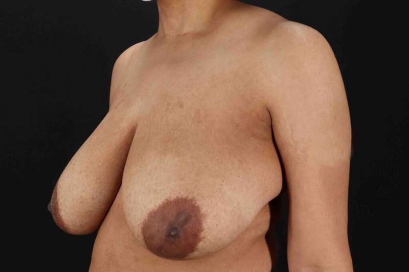 Breast Lift Before & After Patient #1159
