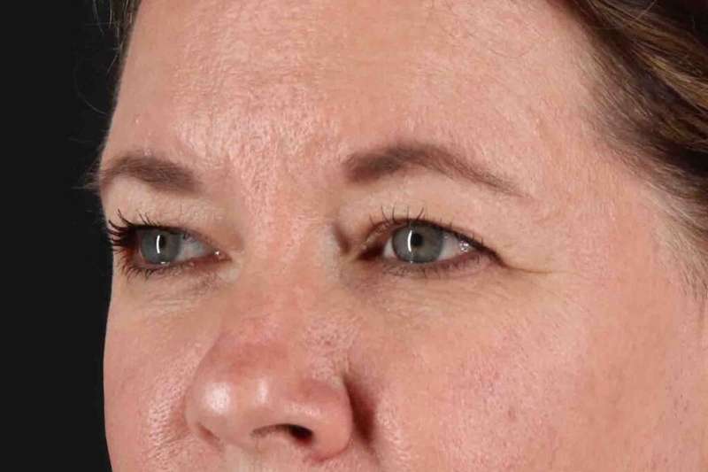 Brow Lift Before & After Patient #1566