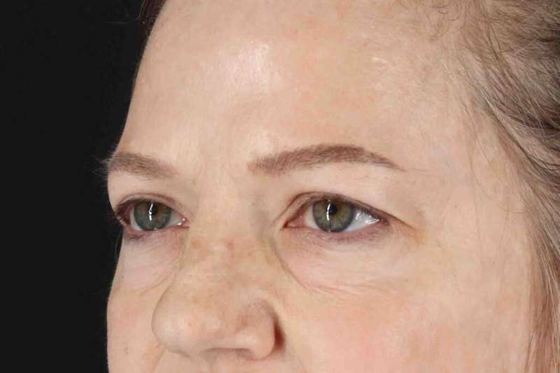 Brow Lift Before & After Patient #1577