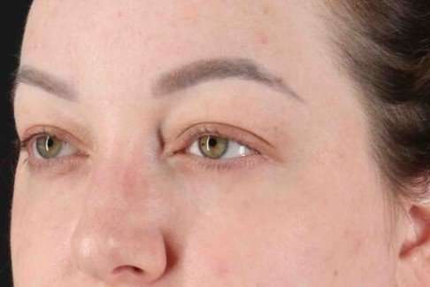 Brow Lift Before & After Patient #1588