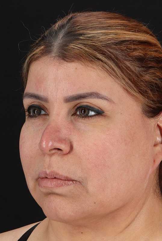 Neck Lift Before & After Patient #1709
