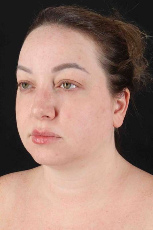 Neck Liposuction Before & After Patient #1742