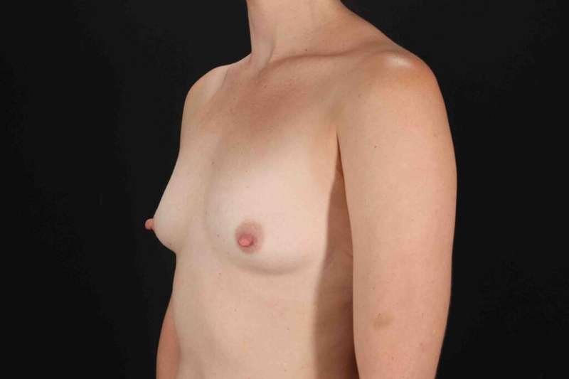 Breast Augmentation with Fat Transfer Before & After Patient #784
