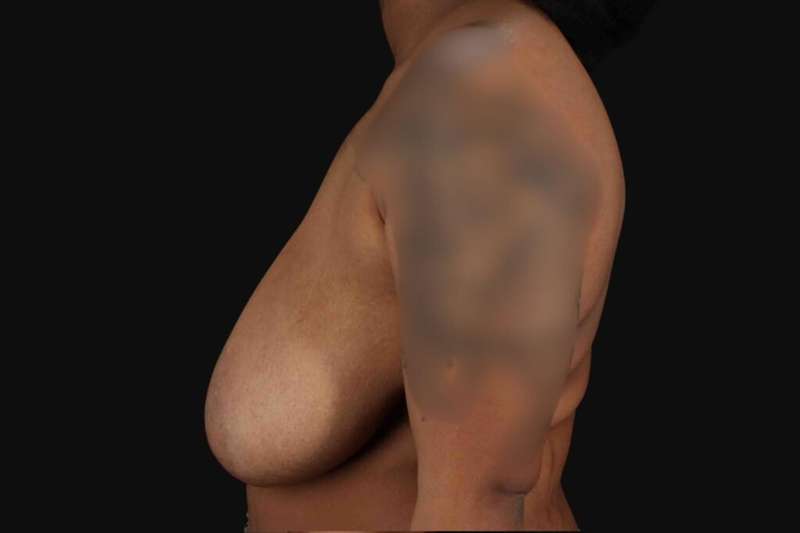 Breast Reduction with Lift Before & After Patient #905