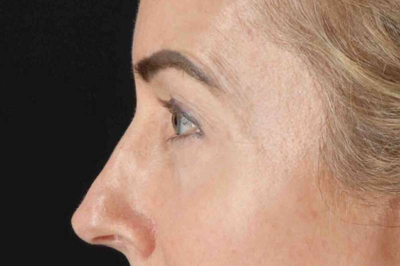 Laser Before & After Patient #2070
