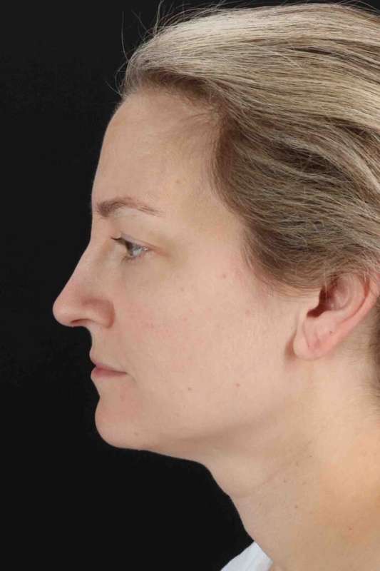Laser Before & After Patient #2081