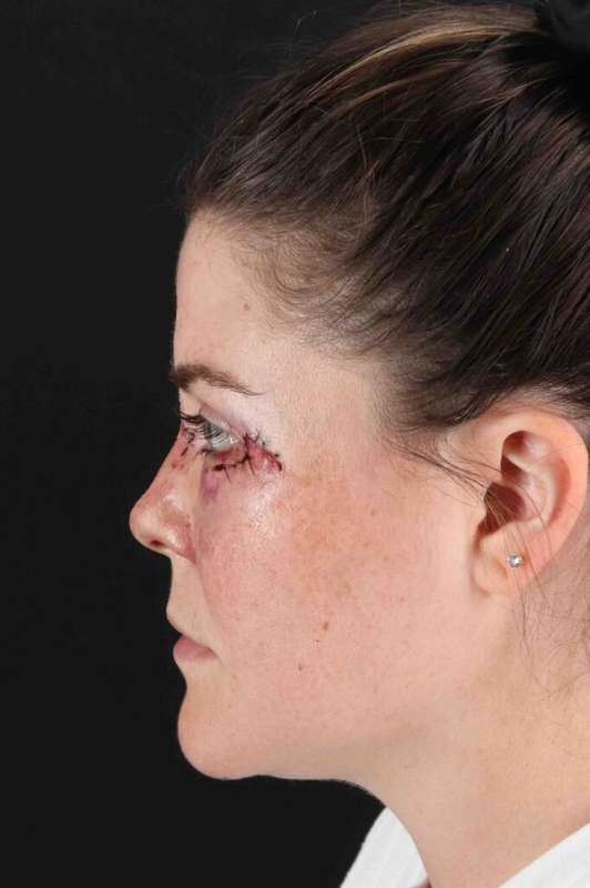 Laser Before & After Patient #2092