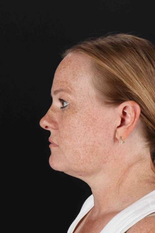 Laser Before & After Patient #2103