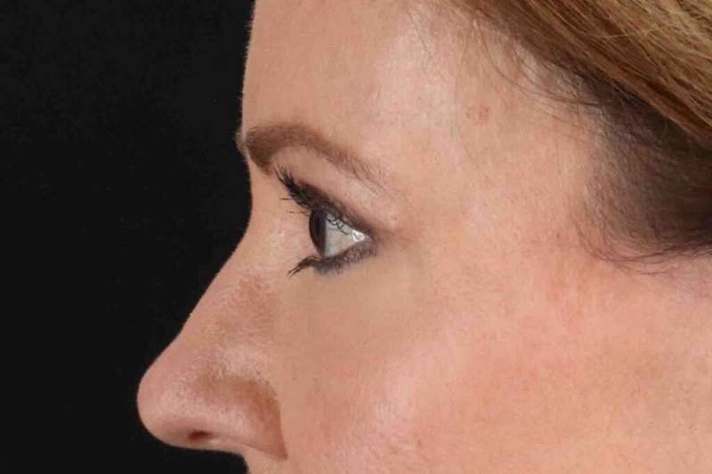 Laser Before & After Patient #2114