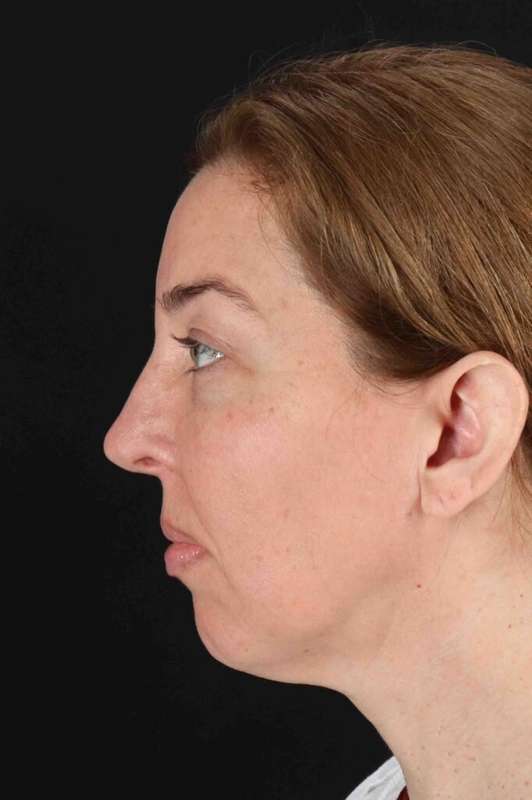 Laser Before & After Patient #2136
