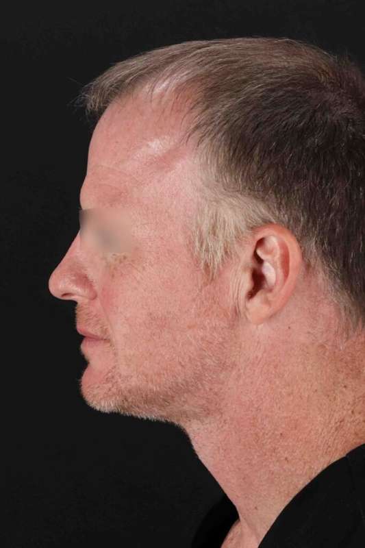 Laser Before & After Patient #2158