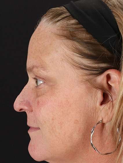 Chemical Peel Before & After Patient #2169