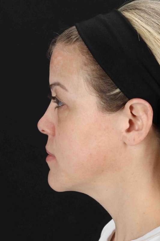 Chemical Peel Before & After Patient #2180