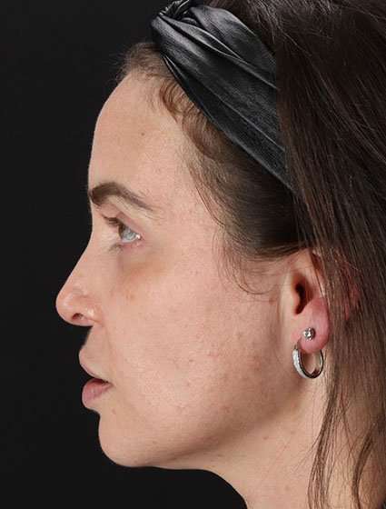 Chemical Peel Before & After Patient #2202