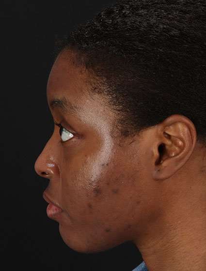 Chemical Peel Before & After Patient #2213