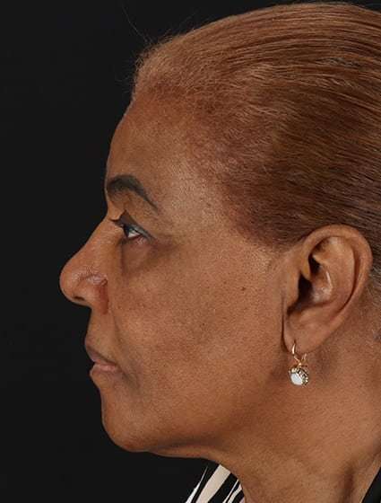 Chemical Peel Before & After Patient #2227