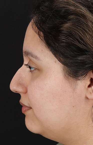 Cosmetic Injectables Before & After Patient #2253