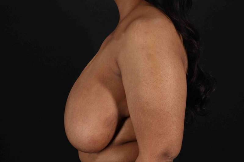Breast Reduction with Lift Before & After Patient #928