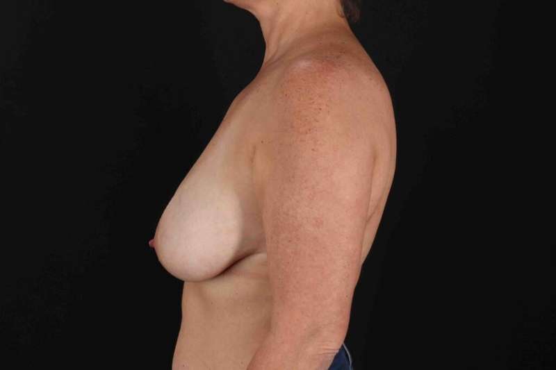 Breast Reduction with Lift Before & After Patient #939