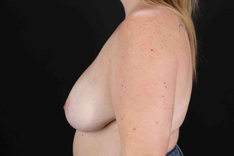 Breast Reduction with Lift Before & After Patient #961