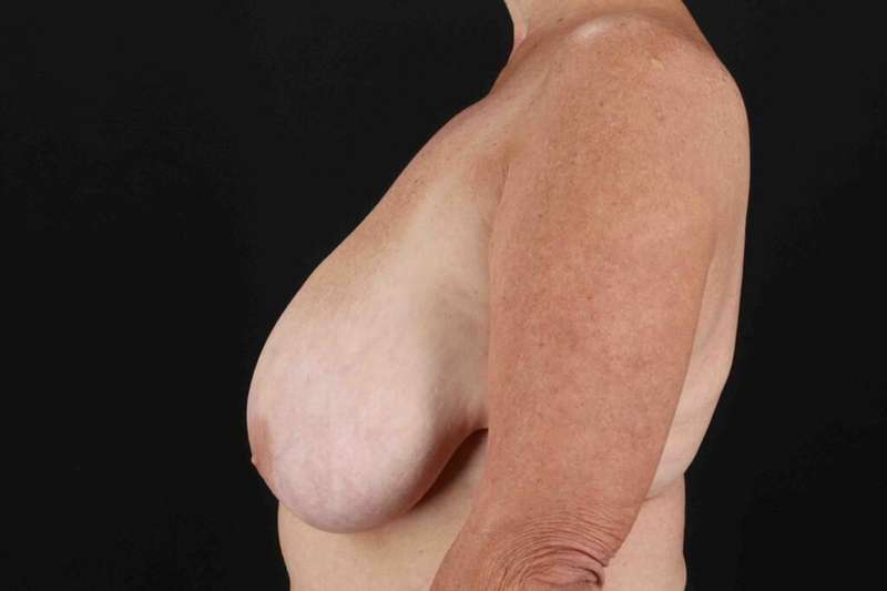Breast Reduction with Lift Before & After Patient #1016