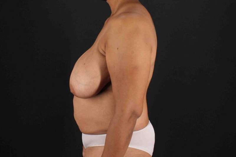 Breast Reconstruction Before & After Patient #1038