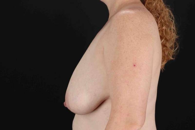 Breast Lift Before & After Patient #1115