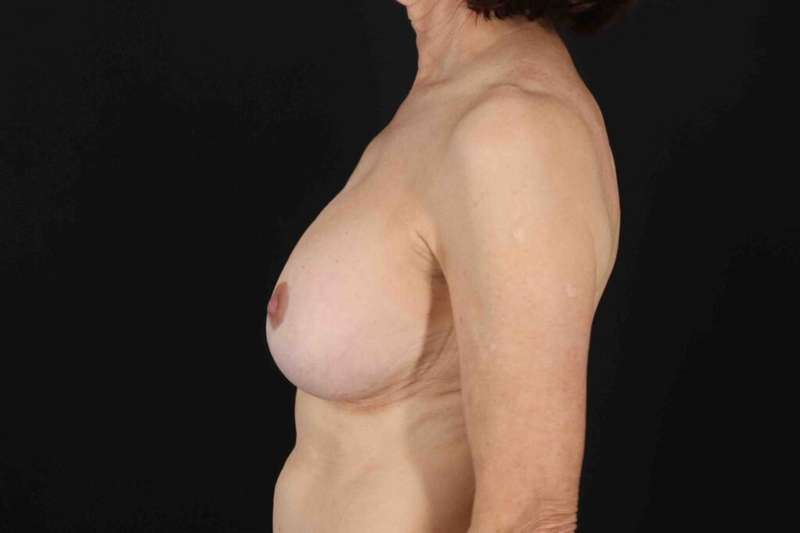 Breast Lift Before & After Patient #1137