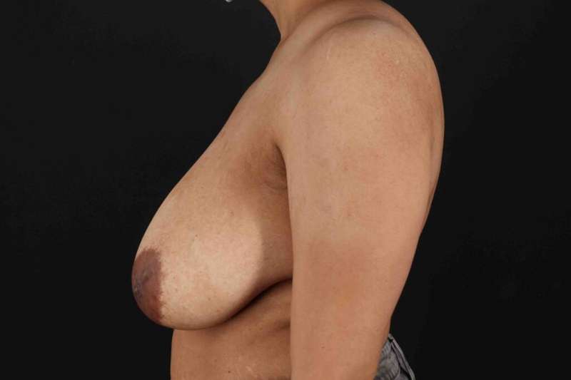 Breast Lift Before & After Patient #1159