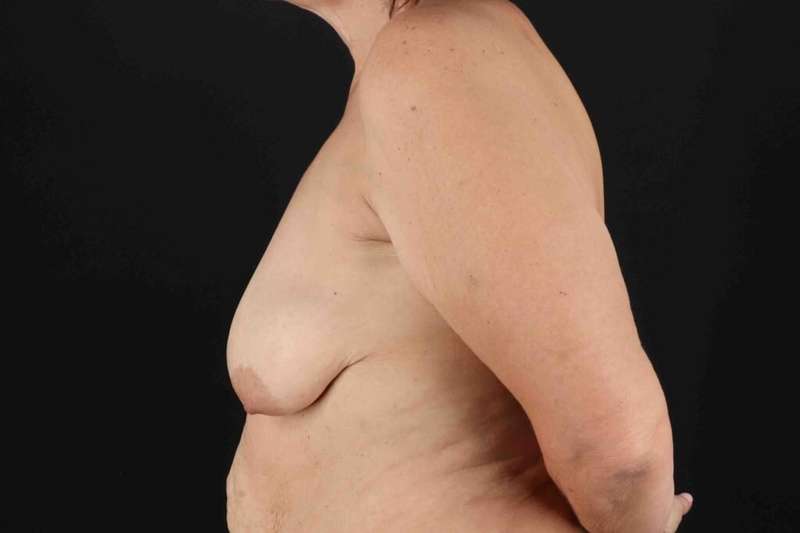 Breast Lift Before & After Patient #1192