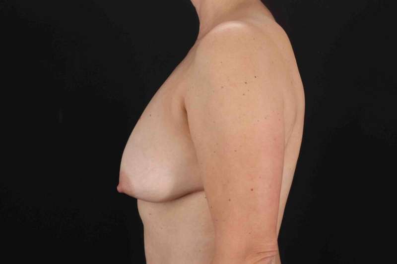 Breast Augmentation with Implants Before & After Patient #1225