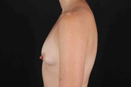 Breast Augmentation with Fat Transfer Before & After Patient #784