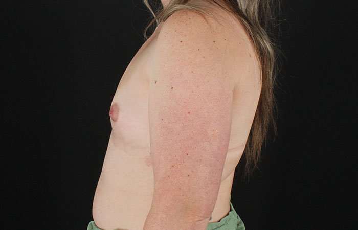 Breast Augmentation with Implants Before & After Patient #1258