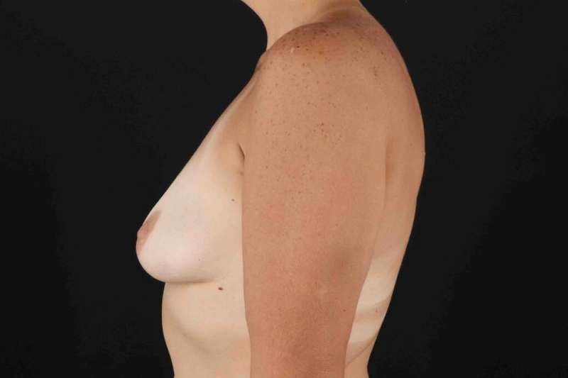 Breast Augmentation with Implants Before & After Patient #1269