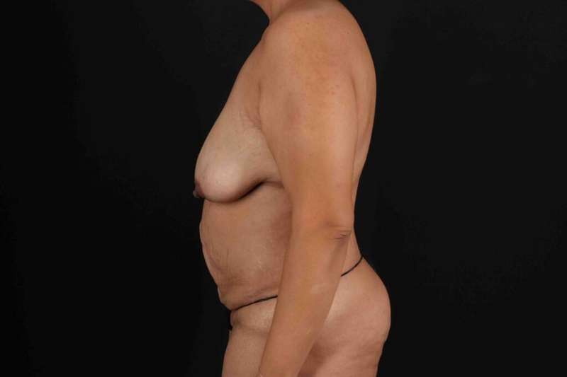 Mommy Makeover Before & After Patient #1299