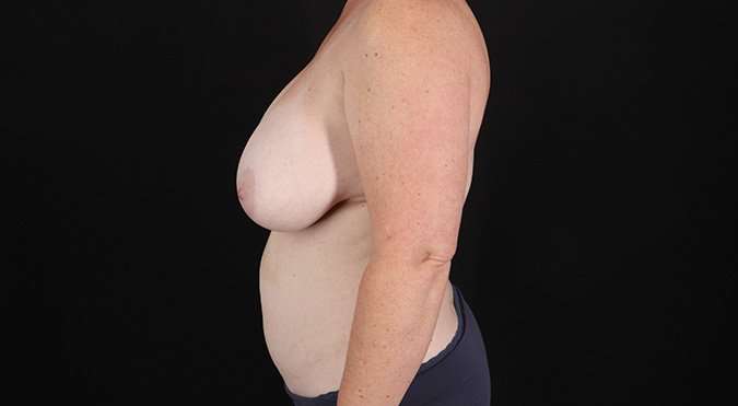 Mommy Makeover Before & After Patient #1342
