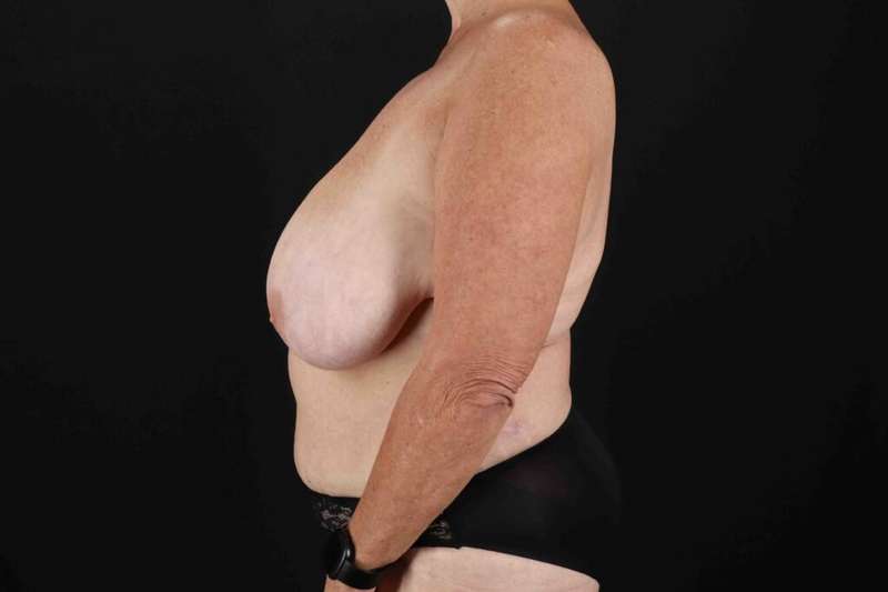 Tummy Tuck Before & After Patient #1515